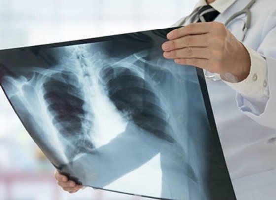 Akciğer Enfeksiyonu Nedir, Neden Olur? Akciğer Enfeksiyonu Tedavisi Nasıl Yapılır?